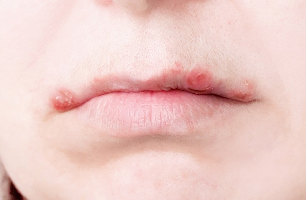 Mụn nước ở mặt và xung quanh miệng thường do virus Herpes gây ra